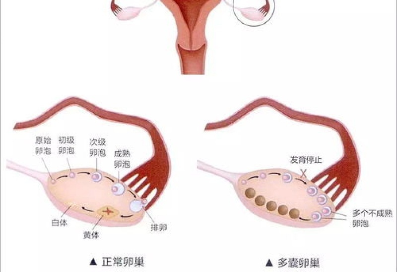 多囊卵巢是什么意思