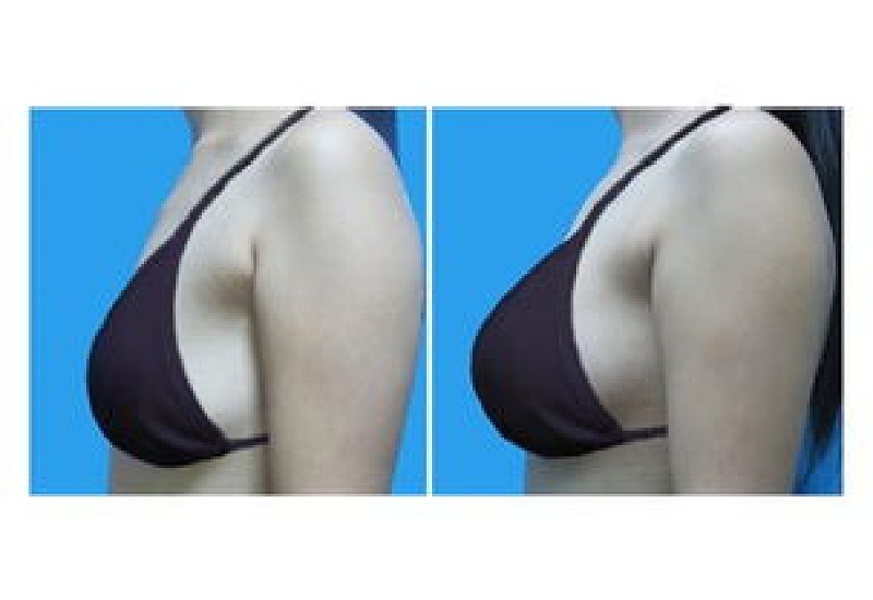 乳房下垂矫正手术有效吗