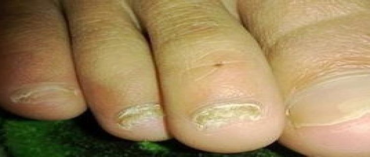 脚趾甲里有泥特别臭?