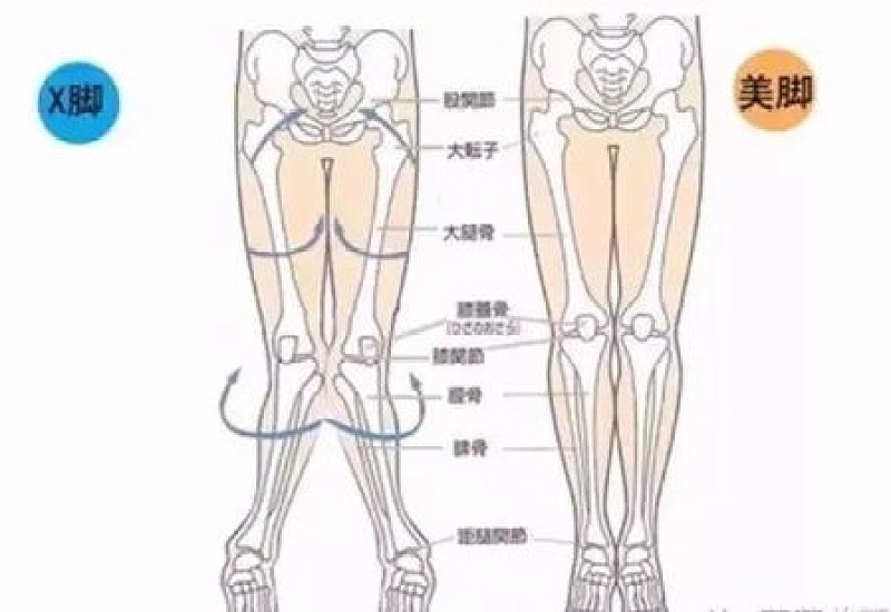X型腿的矫正方法