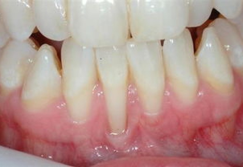 牙龈萎缩怎么办呢？