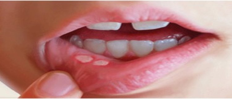 口腔溃疡是什么原因