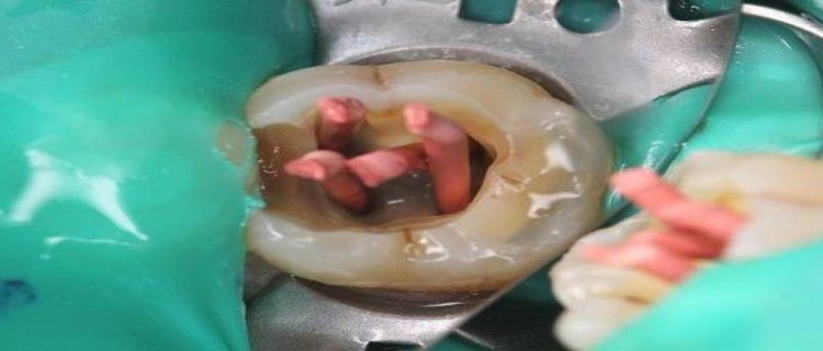 绍兴种牙能用医保报销吗2023？
