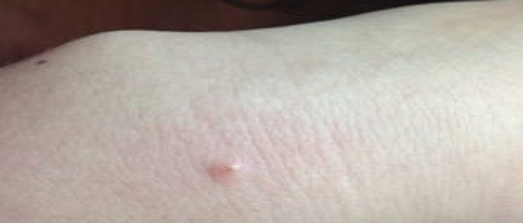 手背上长了好多小红点点脱皮，这是怎么了，会传染吗？