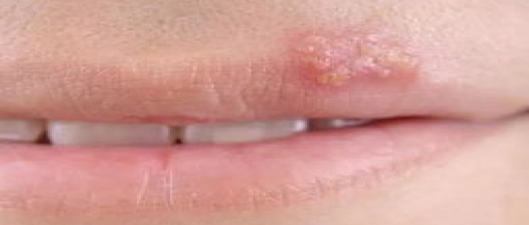 口唇疱疹是什么引起的 口唇疱疹怎么引起的