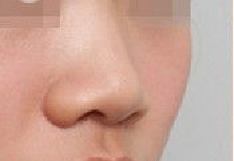假体隆鼻什么材料好 假体隆鼻材料有哪些种类